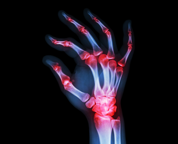 Rheumatoid arthritis is an autoimmune condition where chronic inflammation damages the joints
